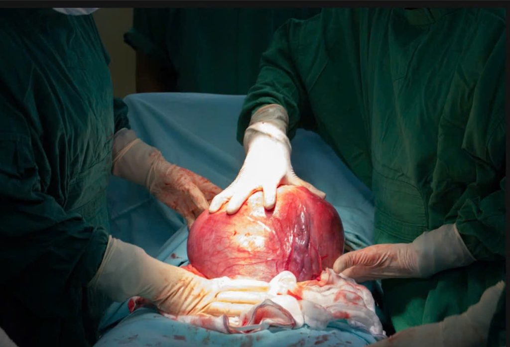 PHẪU THUẬT THÀNH CÔNG KHỐI U XƠ TỬ CUNG NẶNG 5KG