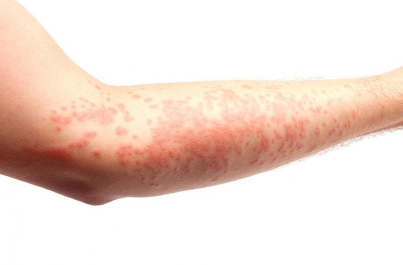 Aquagenic Urticaria (Water Allergy)