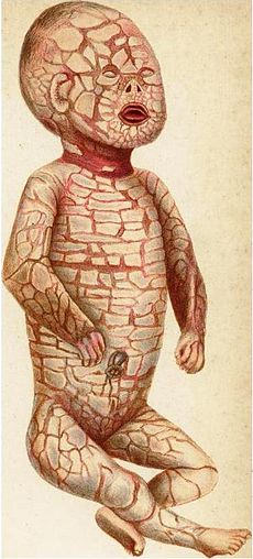 Harlequin Ichthyosis