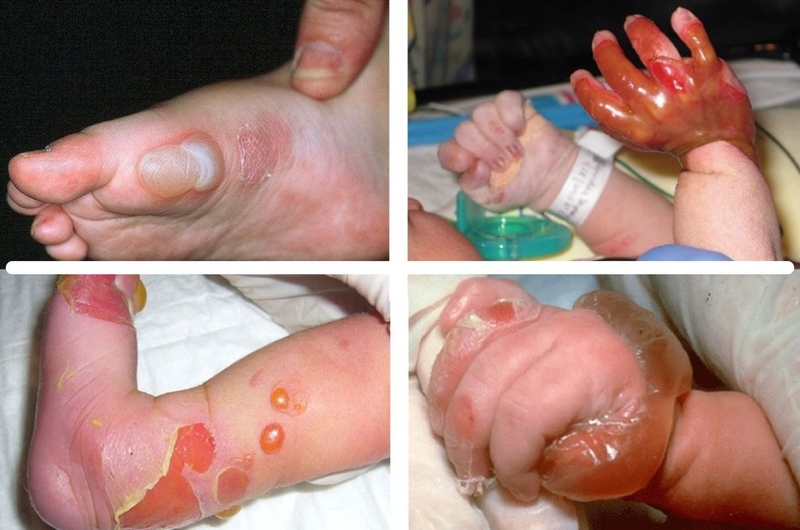 Epidermolysis Bullosa (EB)