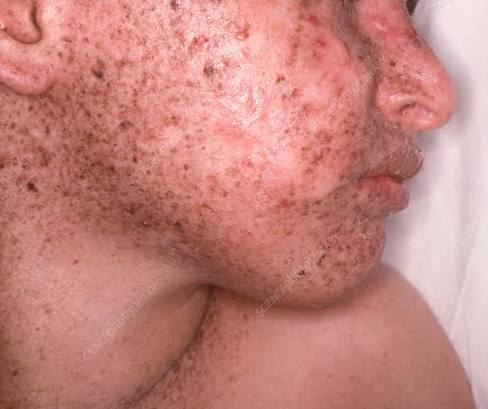 Xeroderma Pigmentosum (XP)