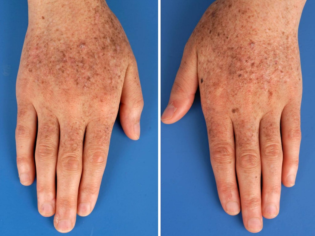 xeroderma-pigmentosum